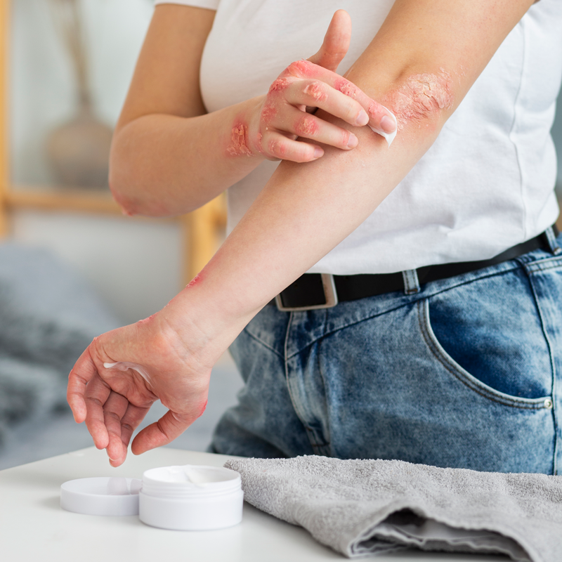 blogartikel-schuppenflechte_behandlungsmöglichkeiten